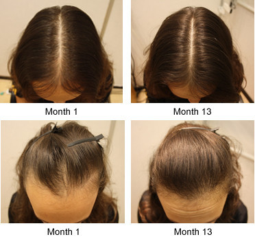 Hasil nyata sunburst pertumbuhan rambut 6 in1 shou Bang rambut tambahan cairan rambut padat